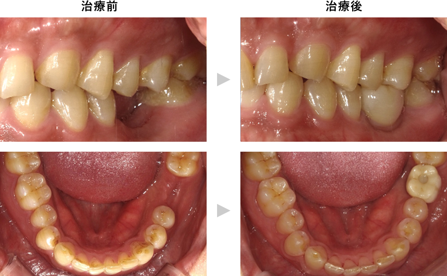 奥歯のインプラント埋入治療