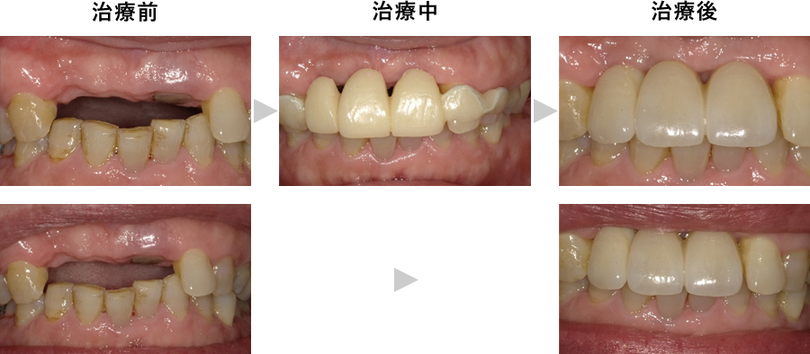 前歯の抜歯同時インプラント埋入
